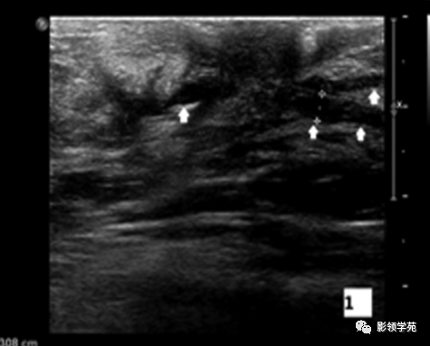 影像PPT - 浆细胞性乳腺炎影像表现-3