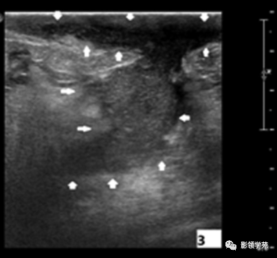 影像PPT - 浆细胞性乳腺炎影像表现-5