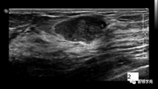 影像PPT - 浆细胞性乳腺炎影像表现-4