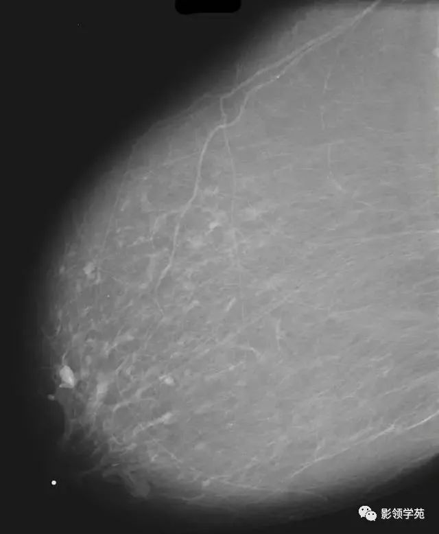 影像PPT - 浆细胞性乳腺炎影像表现-10