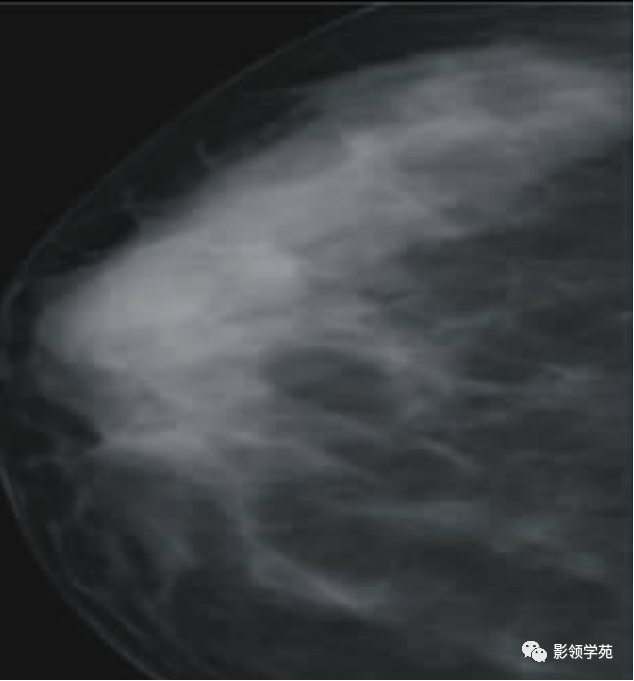影像PPT - 浆细胞性乳腺炎影像表现-8
