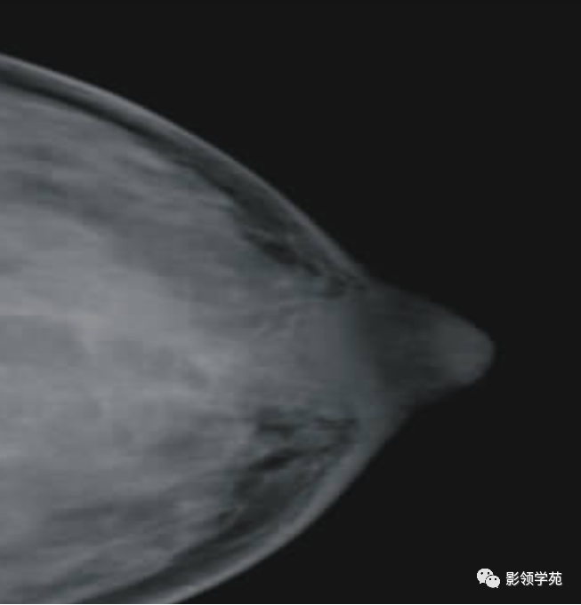 影像PPT - 浆细胞性乳腺炎影像表现-9