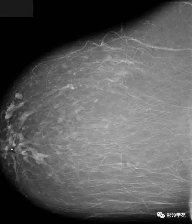 影像PPT - 浆细胞性乳腺炎影像表现-12