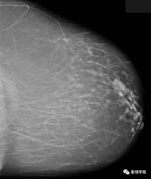 影像PPT - 浆细胞性乳腺炎影像表现-13