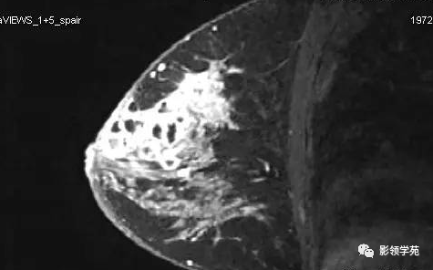 影像PPT - 浆细胞性乳腺炎影像表现-25