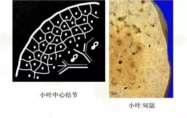 影像PPT - 肺泡解剖结构及肺气肿CT分型-4