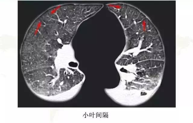 影像PPT - 肺泡解剖结构及肺气肿CT分型-6