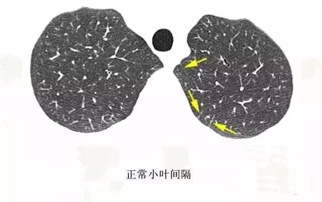 影像PPT - 肺泡解剖结构及肺气肿CT分型-8