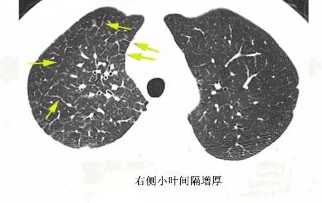 影像PPT - 肺泡解剖结构及肺气肿CT分型-9