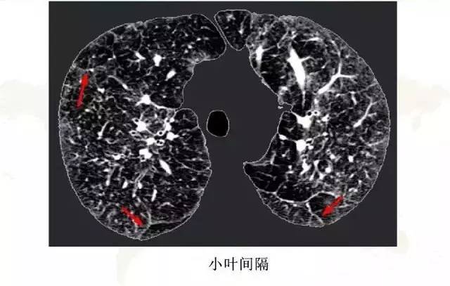 影像PPT - 肺泡解剖结构及肺气肿CT分型-7