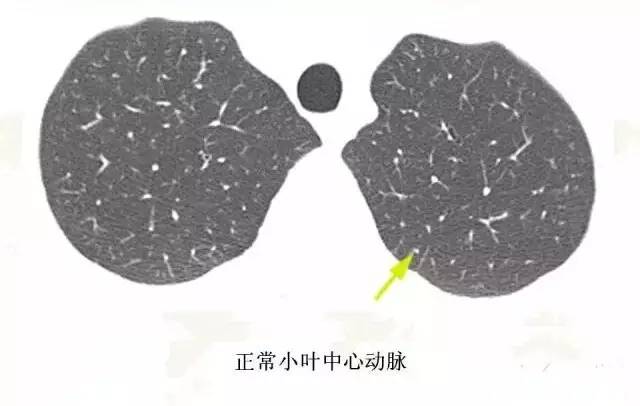 影像PPT - 肺泡解剖结构及肺气肿CT分型-10