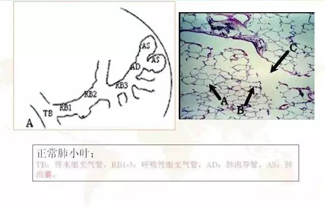 影像PPT - 肺泡解剖结构及肺气肿CT分型-12