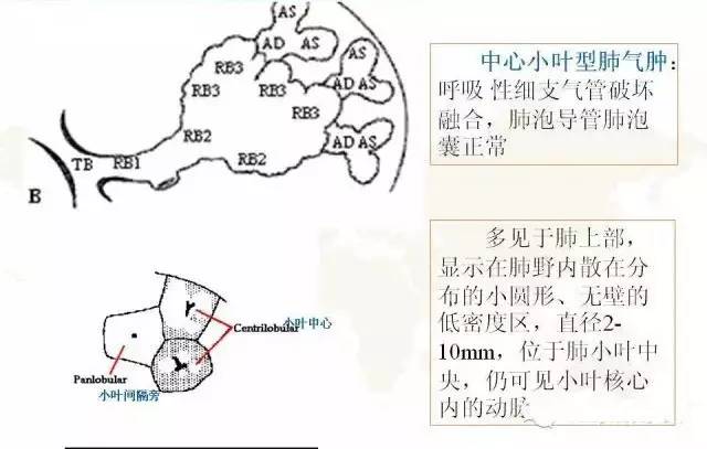 影像PPT - 肺泡解剖结构及肺气肿CT分型-13
