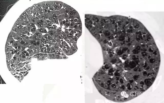 影像PPT - 肺泡解剖结构及肺气肿CT分型-16