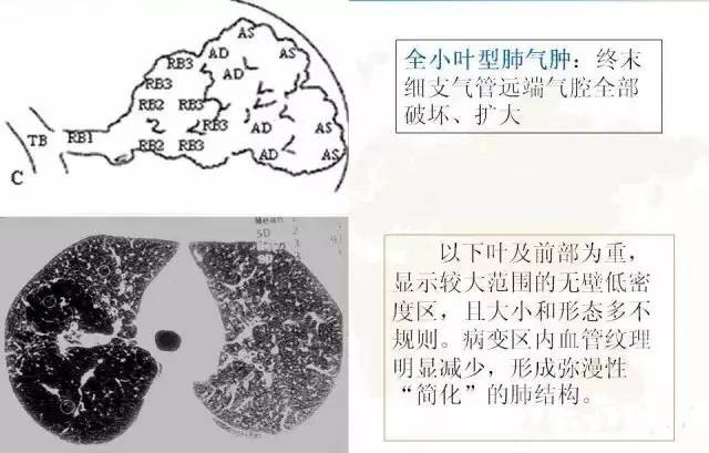 影像PPT - 肺泡解剖结构及肺气肿CT分型-17