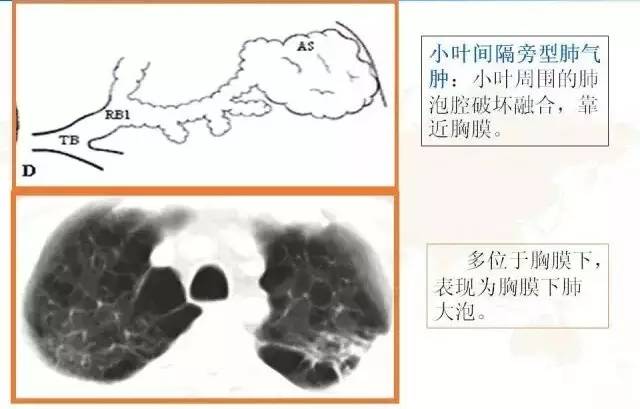影像PPT - 肺泡解剖结构及肺气肿CT分型-21