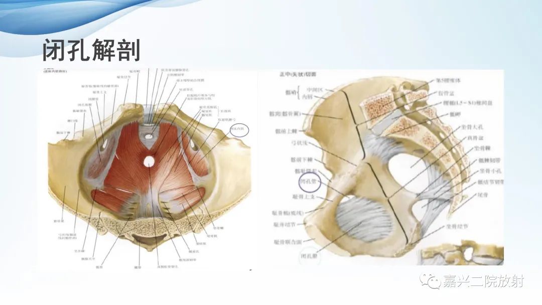 影像PPT - 【PPT】闭孔疝CT表现-3