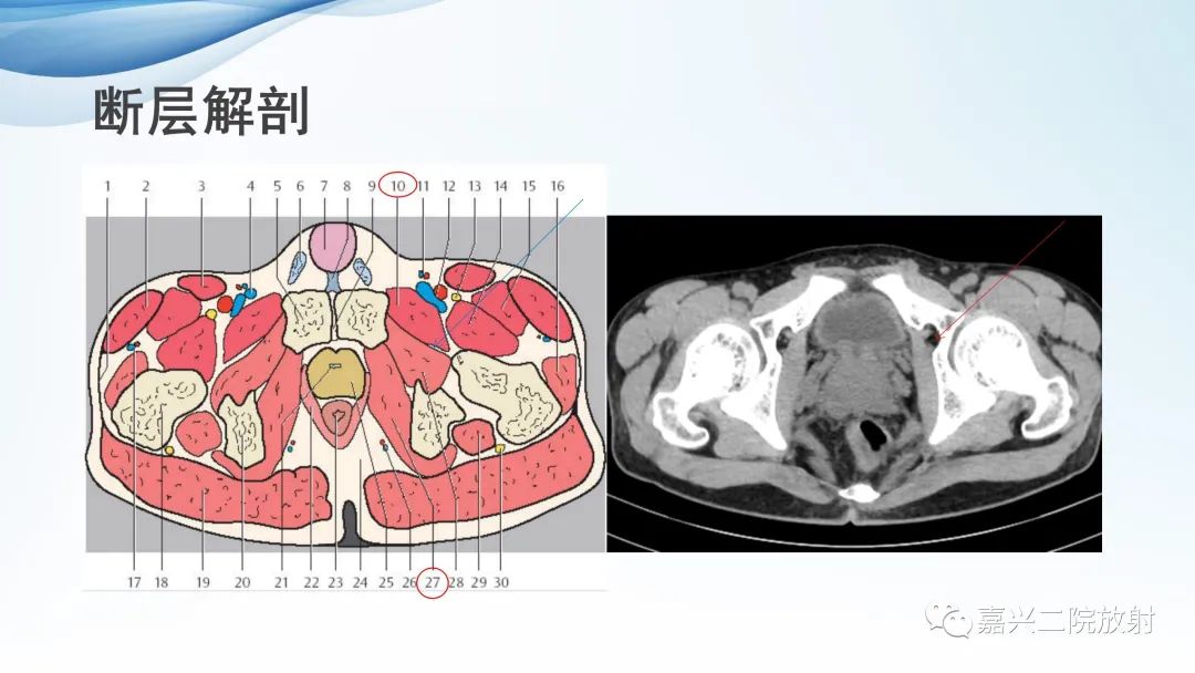 影像PPT - 【PPT】闭孔疝CT表现-4
