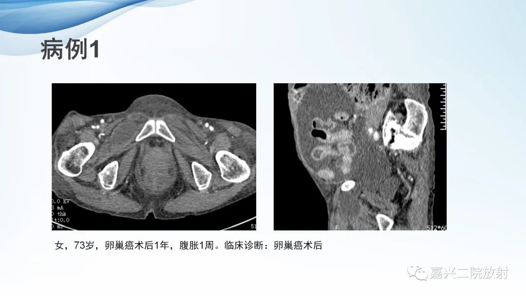 影像PPT - 【PPT】闭孔疝CT表现-10
