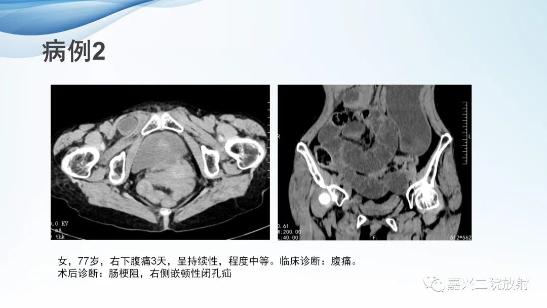 影像PPT - 【PPT】闭孔疝CT表现-11