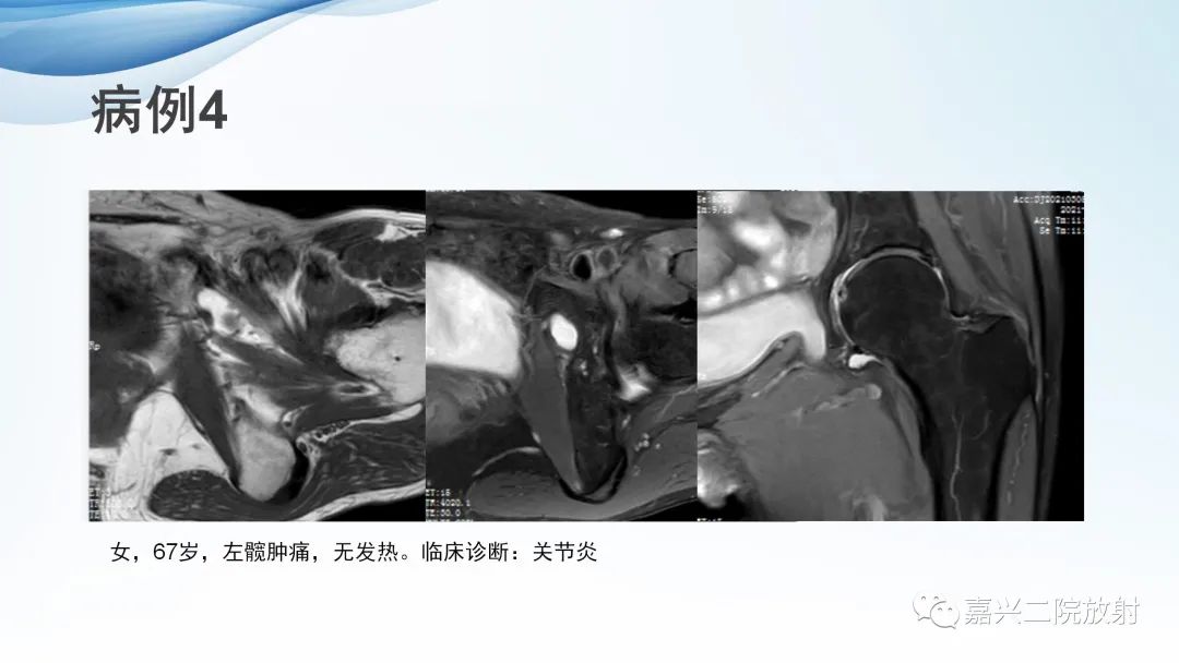 影像PPT - 【PPT】闭孔疝CT表现-13