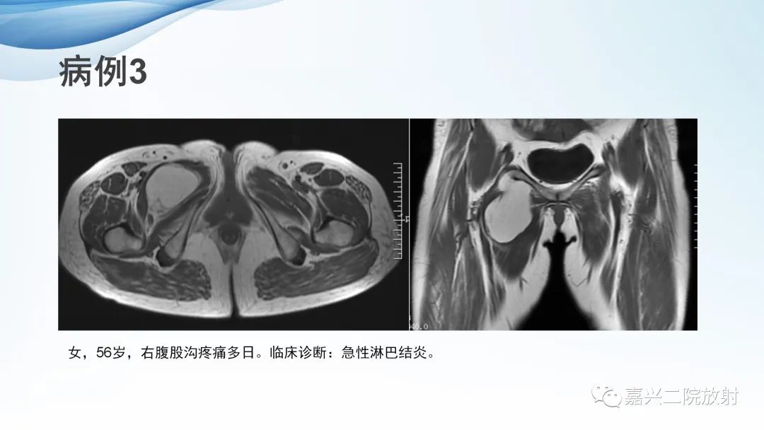 影像PPT - 【PPT】闭孔疝CT表现-12