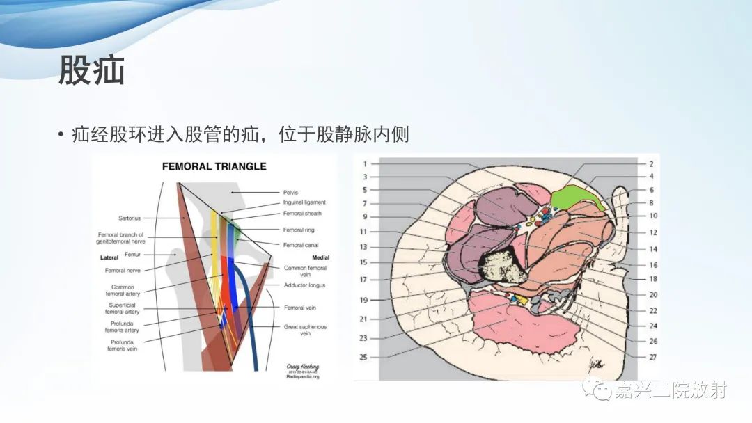 影像PPT - 【PPT】闭孔疝CT表现-15