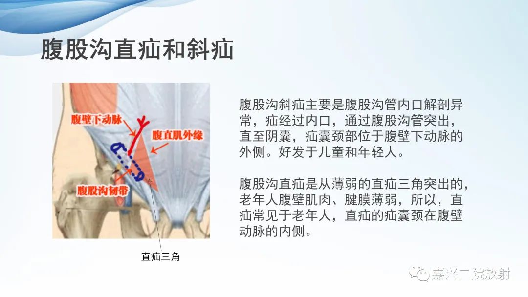 影像PPT - 【PPT】闭孔疝CT表现-17