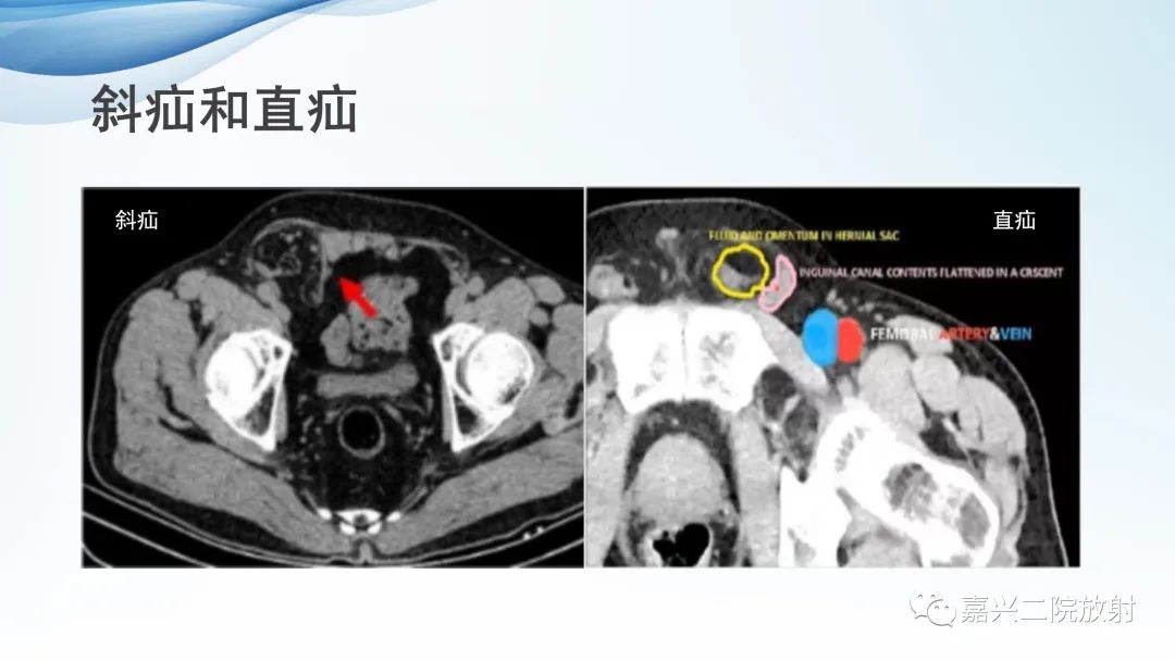 影像PPT - 【PPT】闭孔疝CT表现-18