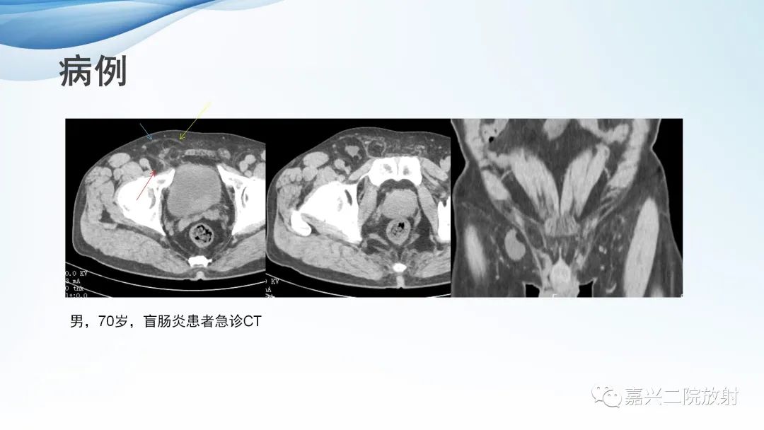 影像PPT - 【PPT】闭孔疝CT表现-19