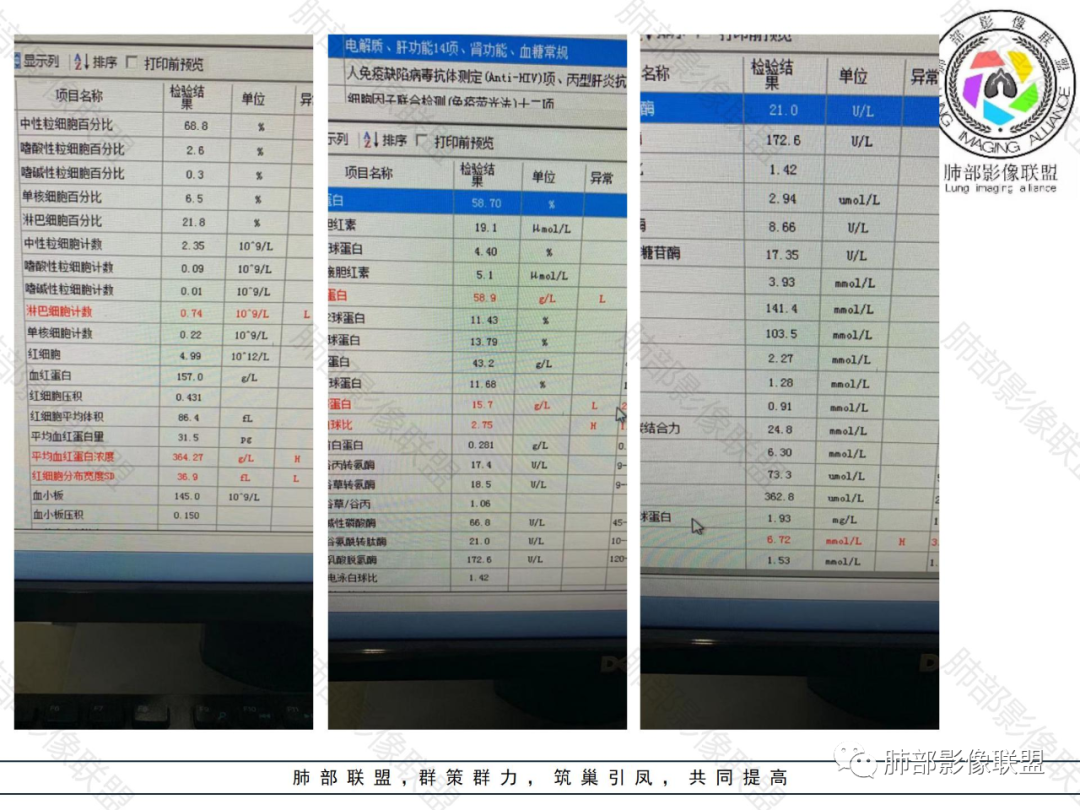 影像PPT - 【病例】肺内淋巴瘤1例CT影像表现-3 影像PPT - 【病例】肺内淋巴瘤1例CT影像表现-3