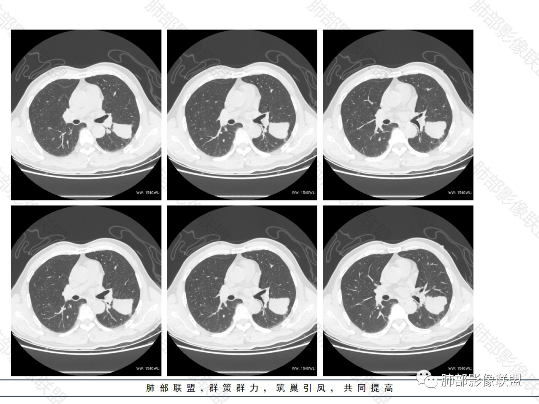 影像PPT - 【病例】肺内淋巴瘤1例CT影像表现-16 影像PPT - 【病例】肺内淋巴瘤1例CT影像表现-16