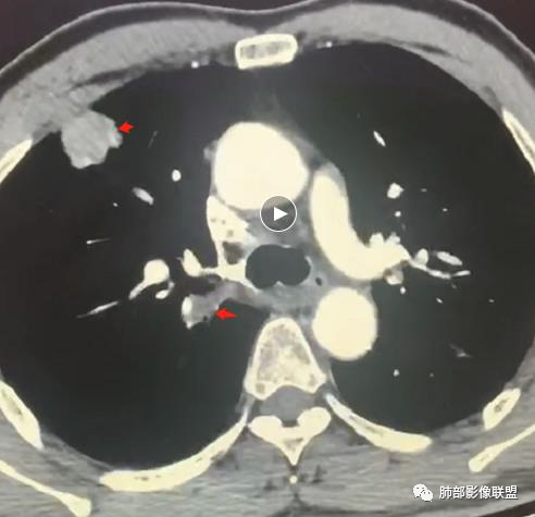 影像PPT - 【病例】肺内淋巴瘤1例CT影像表现-21 影像PPT - 【病例】肺内淋巴瘤1例CT影像表现-21
