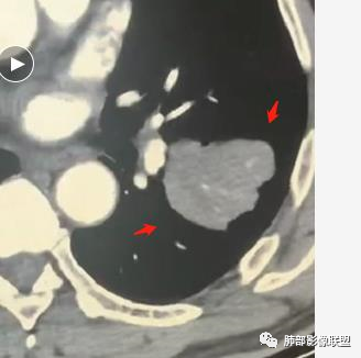 影像PPT - 【病例】肺内淋巴瘤1例CT影像表现-24 影像PPT - 【病例】肺内淋巴瘤1例CT影像表现-24