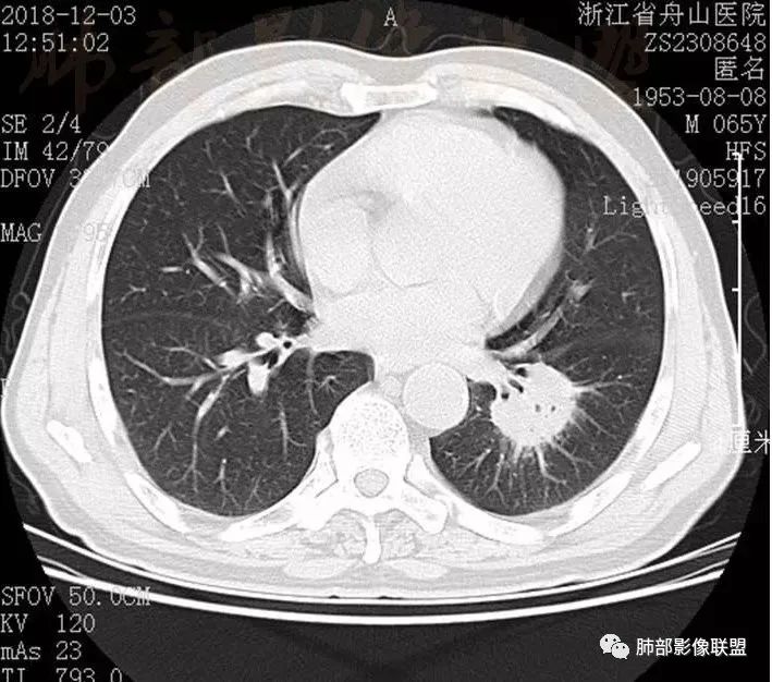 影像PPT - 【病例】肺内淋巴瘤1例CT影像表现-28 影像PPT - 【病例】肺内淋巴瘤1例CT影像表现-28