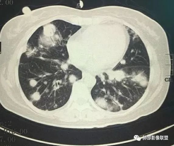 影像PPT - 【病例】肺内淋巴瘤1例CT影像表现-30 影像PPT - 【病例】肺内淋巴瘤1例CT影像表现-30