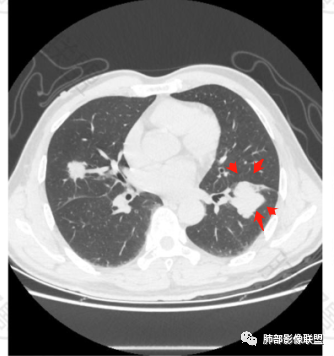 影像PPT - 【病例】肺内淋巴瘤1例CT影像表现-35 影像PPT - 【病例】肺内淋巴瘤1例CT影像表现-35