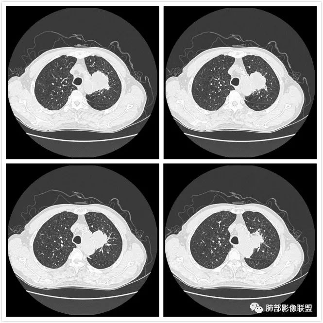 影像PPT - 【肺部影像系列】肿瘤？脓肿？结核？如何洞察秋毫-7