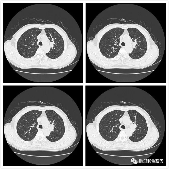影像PPT - 【肺部影像系列】肿瘤？脓肿？结核？如何洞察秋毫-8