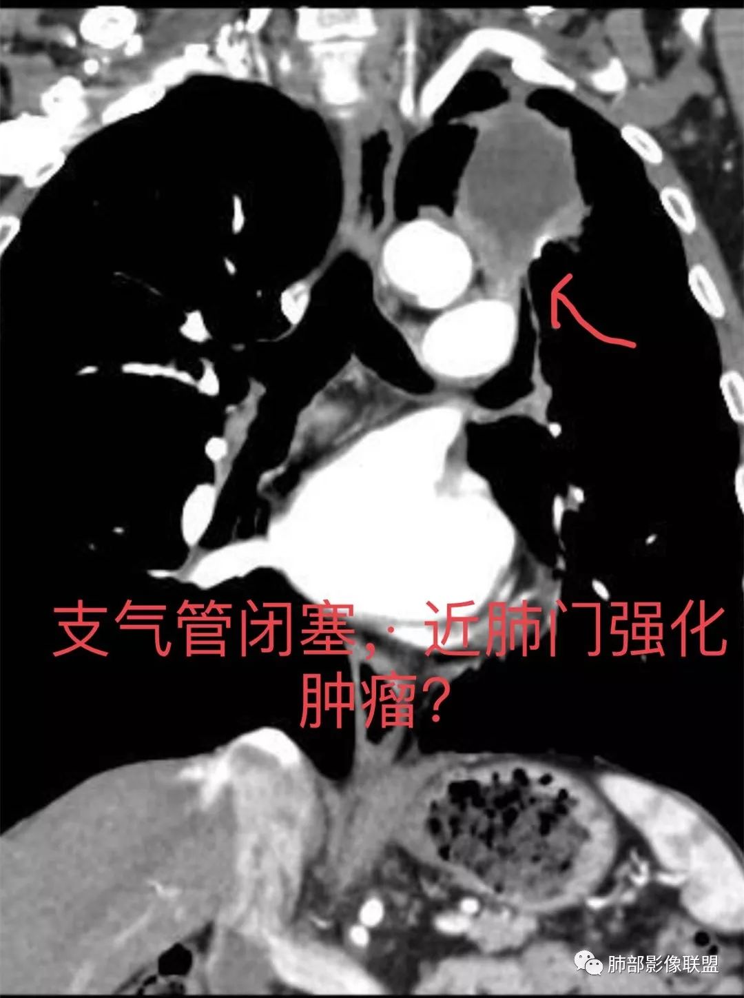 影像PPT - 【肺部影像系列】肿瘤？脓肿？结核？如何洞察秋毫-24
