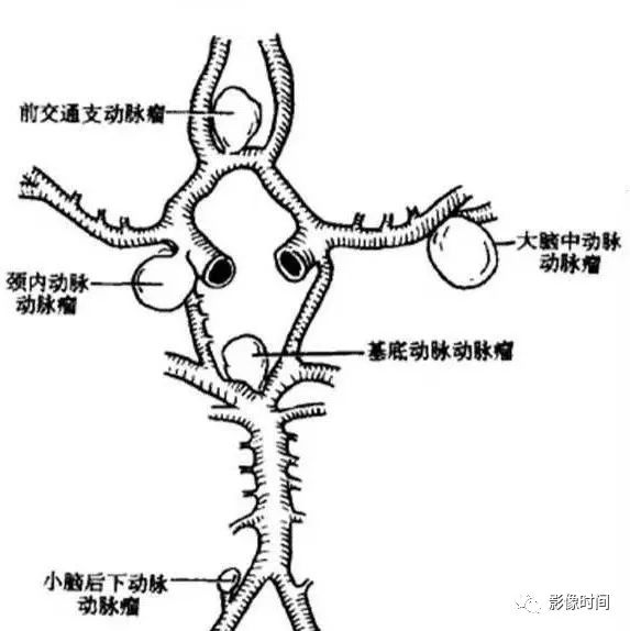 影像PPT - 8 个病例带您一起复习颅内动脉瘤这些知识-2