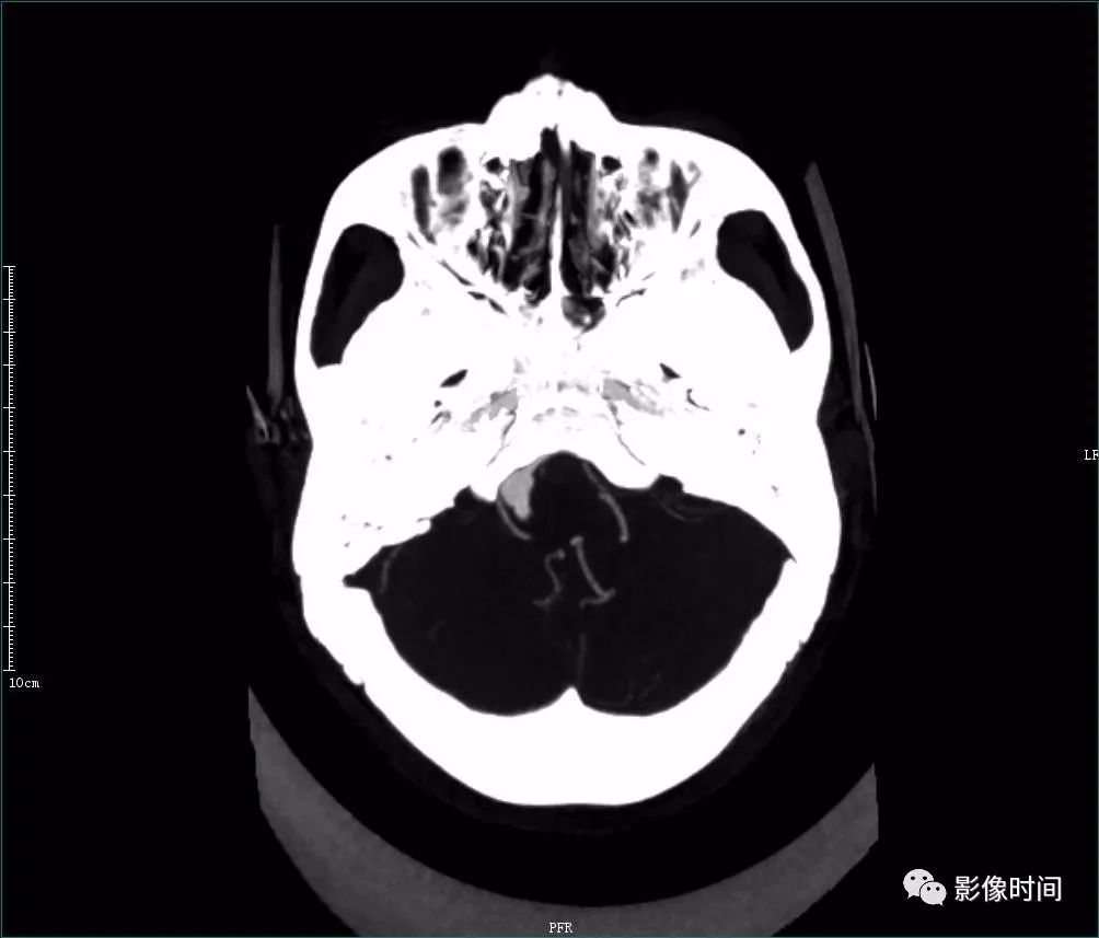 影像PPT - 8 个病例带您一起复习颅内动脉瘤这些知识-25