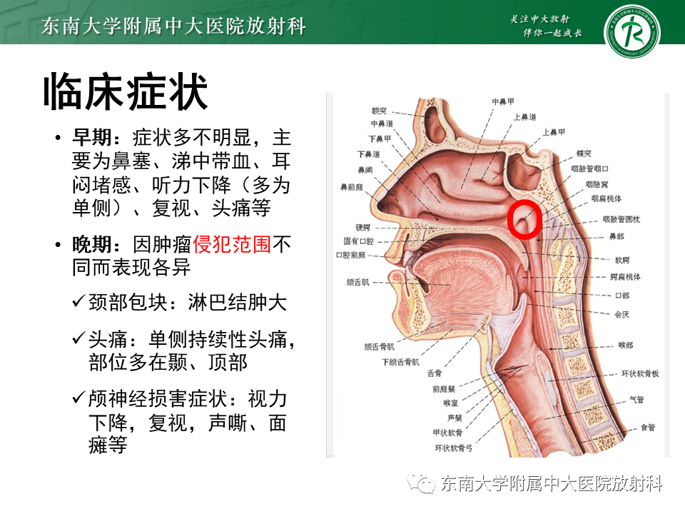 影像PPT - 【PPT】鼻咽癌的影像-5 影像PPT - 【PPT】鼻咽癌的影像-5