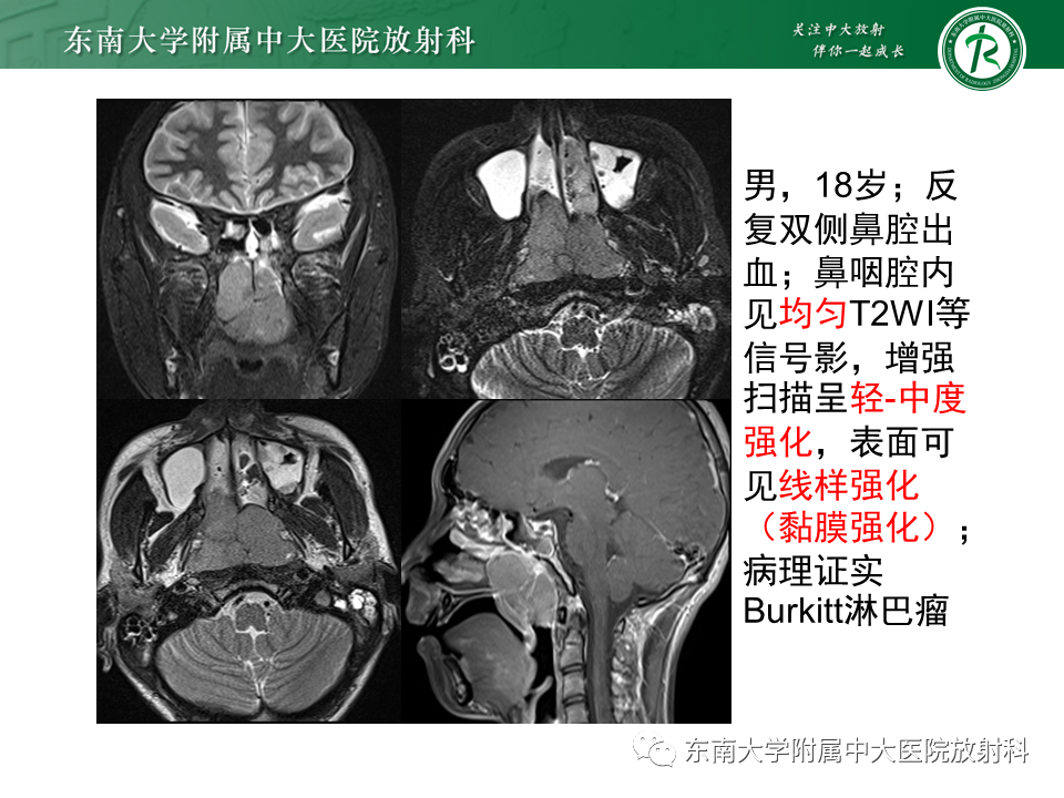 影像PPT - 【PPT】鼻咽癌的影像-14 影像PPT - 【PPT】鼻咽癌的影像-14