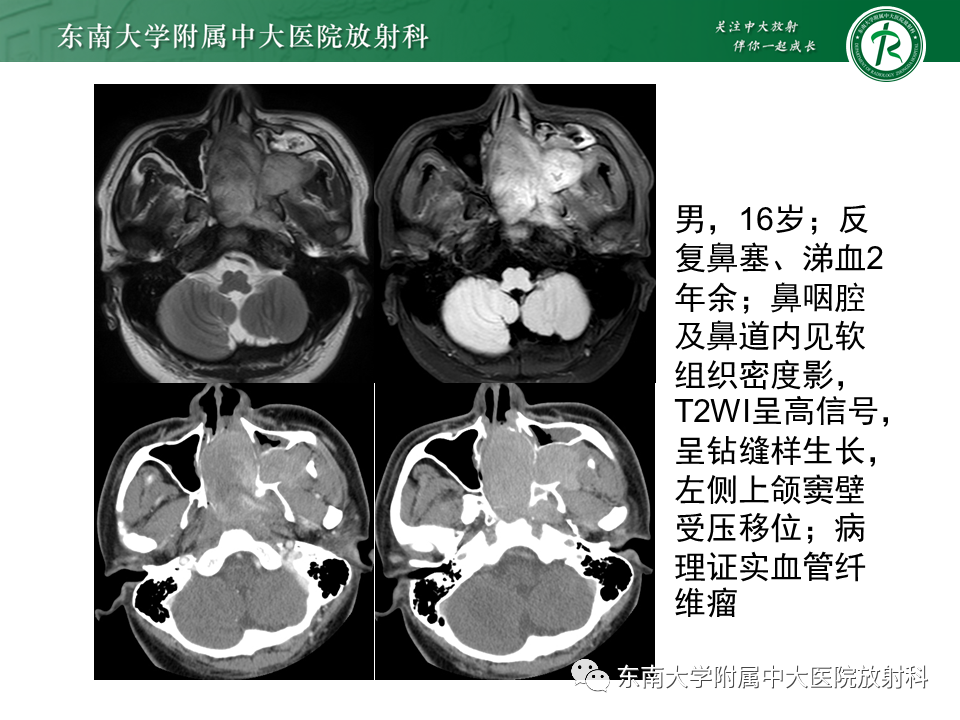 影像PPT - 【PPT】鼻咽癌的影像-16 影像PPT - 【PPT】鼻咽癌的影像-16