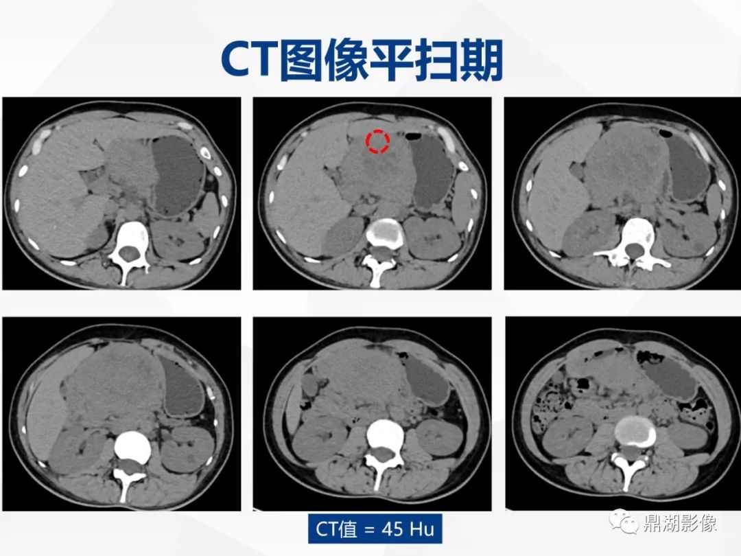 影像PPT - 【病例】胰腺神经内分泌肿瘤不典型病例1例CT及MR影像-3