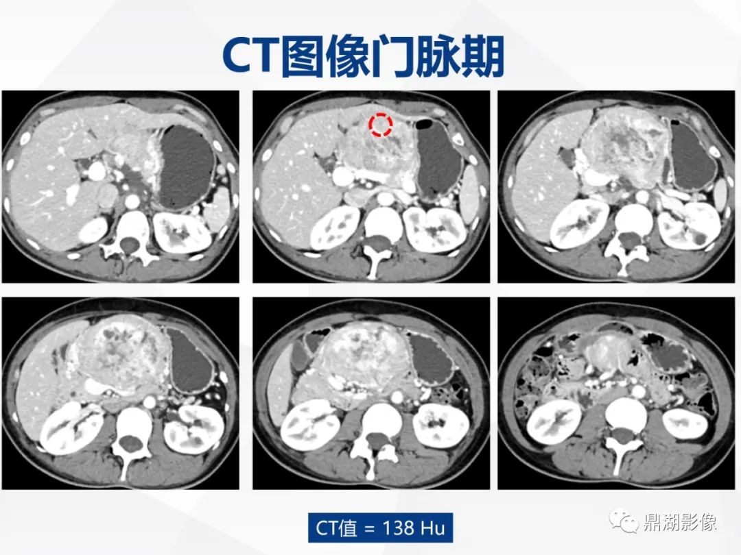 影像PPT - 【病例】胰腺神经内分泌肿瘤不典型病例1例CT及MR影像-5