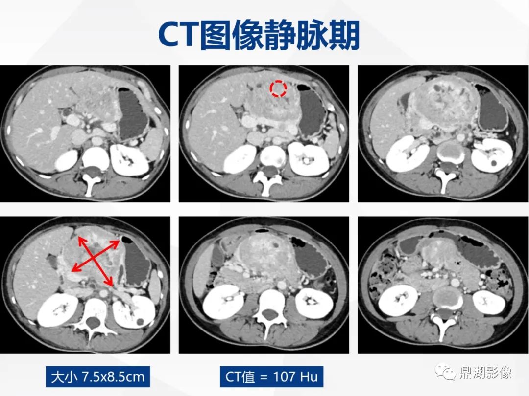 影像PPT - 【病例】胰腺神经内分泌肿瘤不典型病例1例CT及MR影像-6