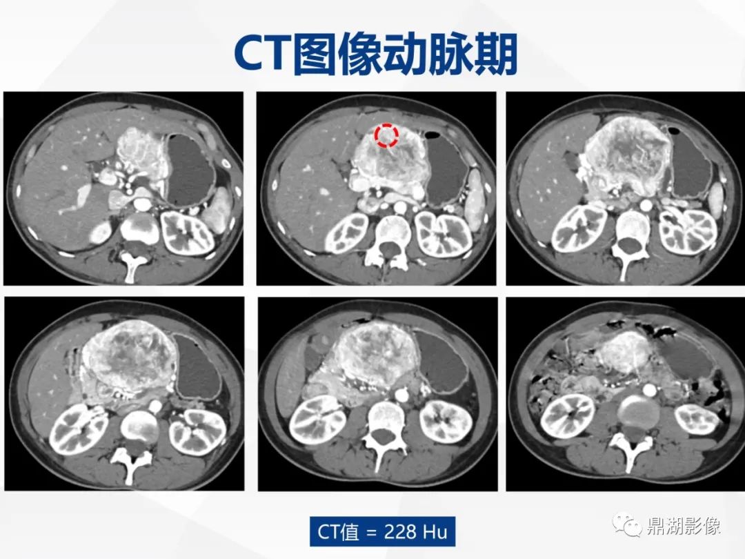 影像PPT - 【病例】胰腺神经内分泌肿瘤不典型病例1例CT及MR影像-4