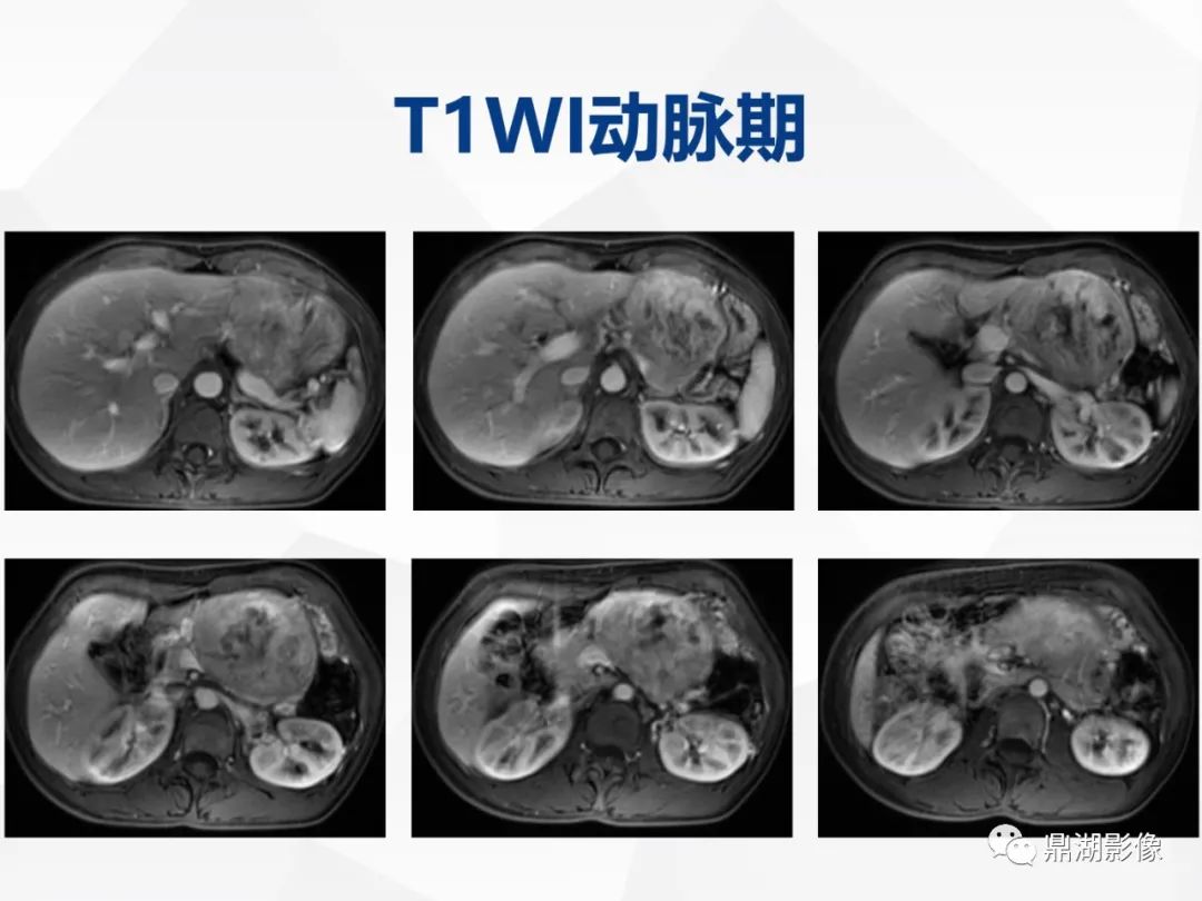 影像PPT - 【病例】胰腺神经内分泌肿瘤不典型病例1例CT及MR影像-11